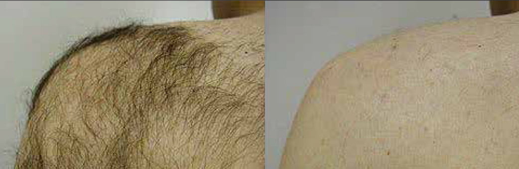 Épilation permanente Épilation permanente