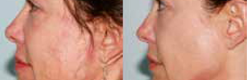 Raffermissement du visage Raffermissement du visage