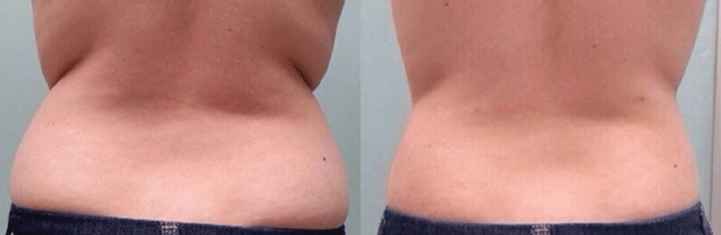 Hot sculpting - alternative à la lipossuccion Hot sculpting - alternative à la lipossuccion