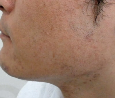 Épilation permanente du visage Épilation permanente du visage
