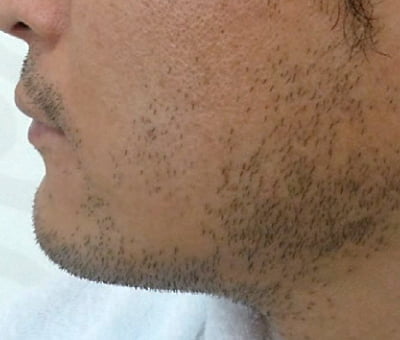 Épilation permanente du visage Épilation permanente du visage