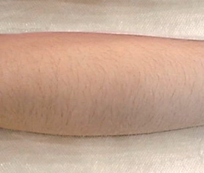 Épilation permanente des bras Épilation permanente des bras