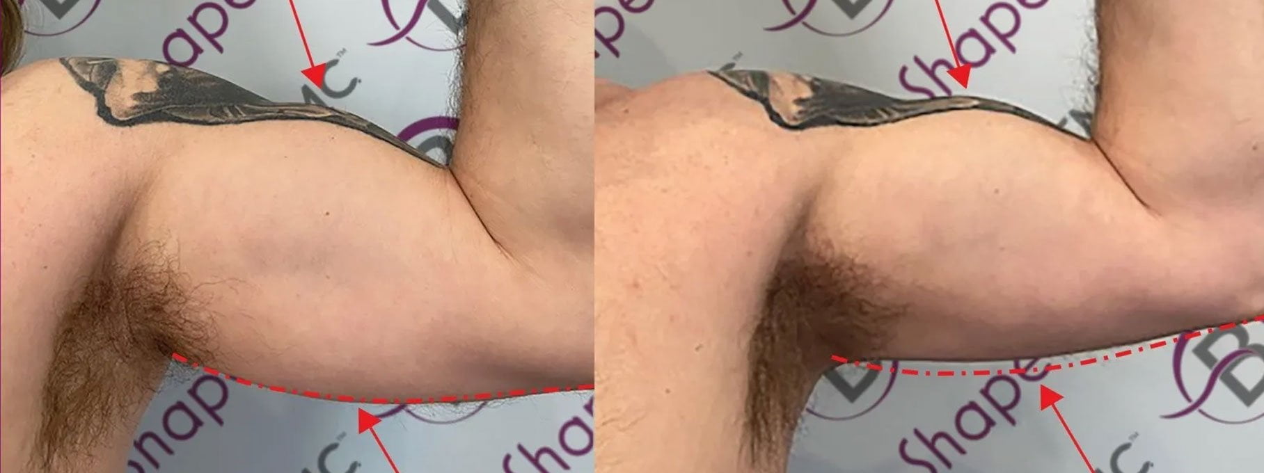 B-Shape TMC biceps B-Shape TMC biceps