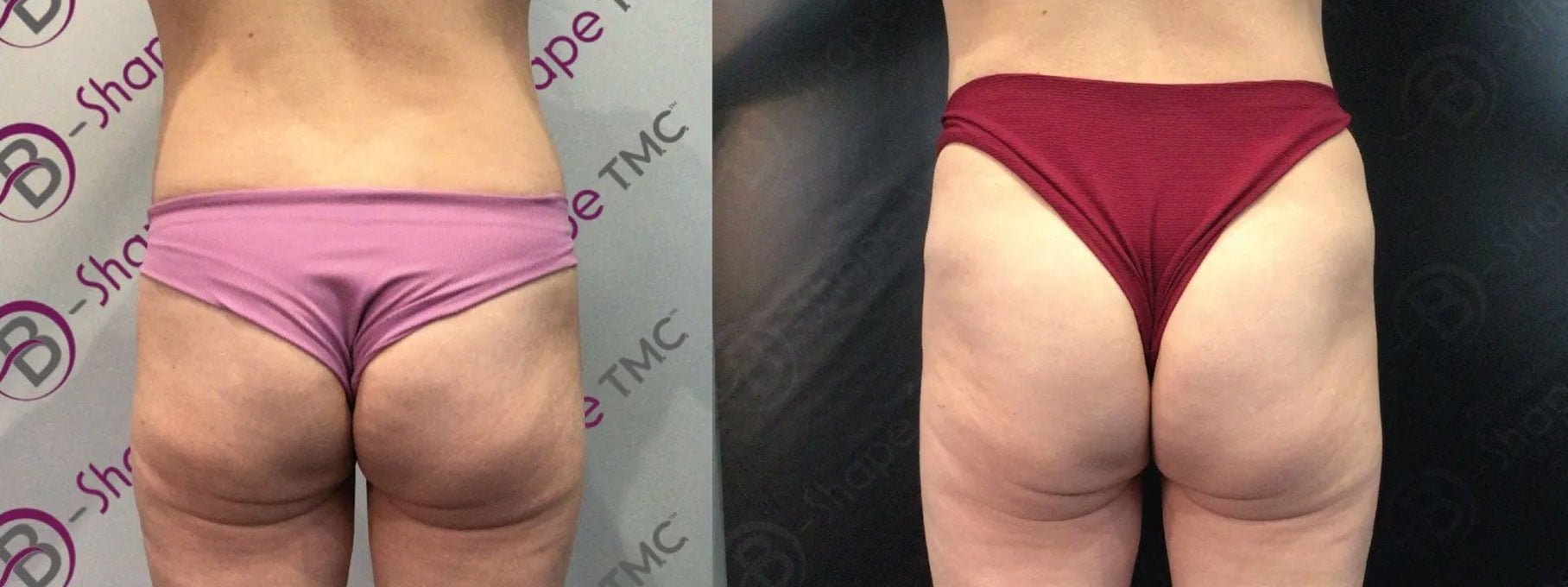 B-Shape TMC fesses B-Shape TMC fesses