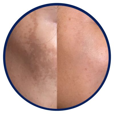 Pigmentation