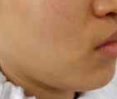 Refresh RF avant Refresh RF avant